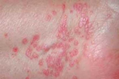 example-of-lichen-planus