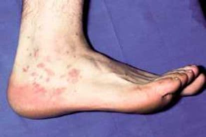 example-of-lichen-planus