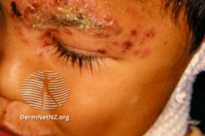 Shingles-example-on-face