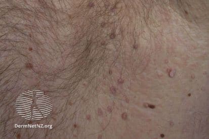 pinnacleskin.com /conditions/skin-tags Carousel 1 Image 2